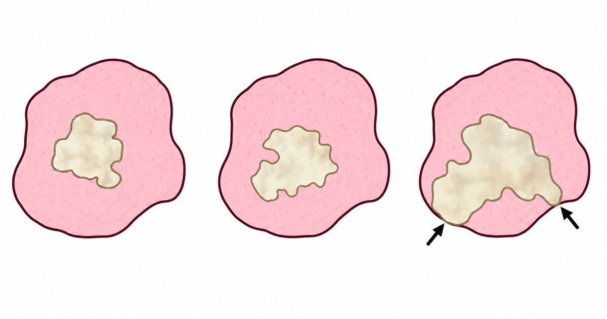 Diagram comparing clean, close, and positive surgical margins